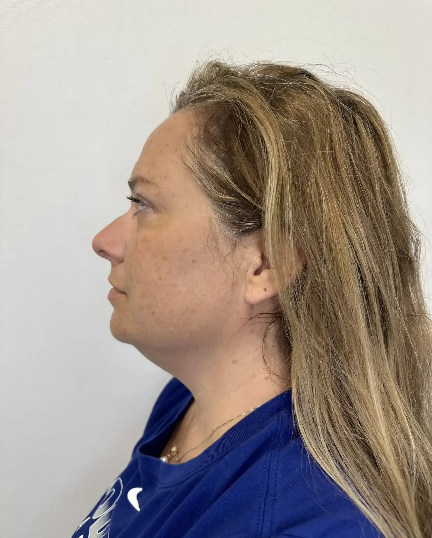 Before treatment — client 4