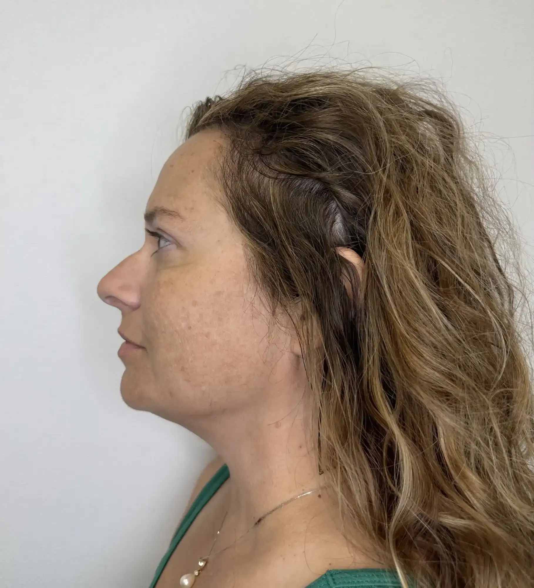 After treatment — client 4